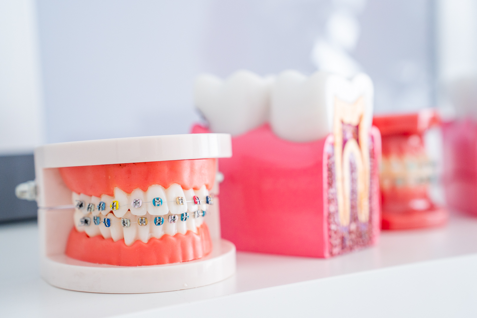 model szczęki z aparatem ortodontycznym